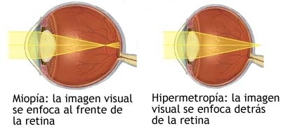 Sobre las lentillas | Lentes-Shop